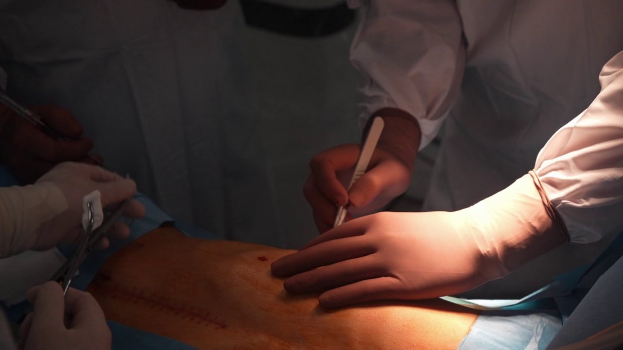 Хирурги удалили деталь катетера из грудной клетки разбившегося о дерево юного лыжника тг-канал (18+) детского хирурга Юрия Козлова